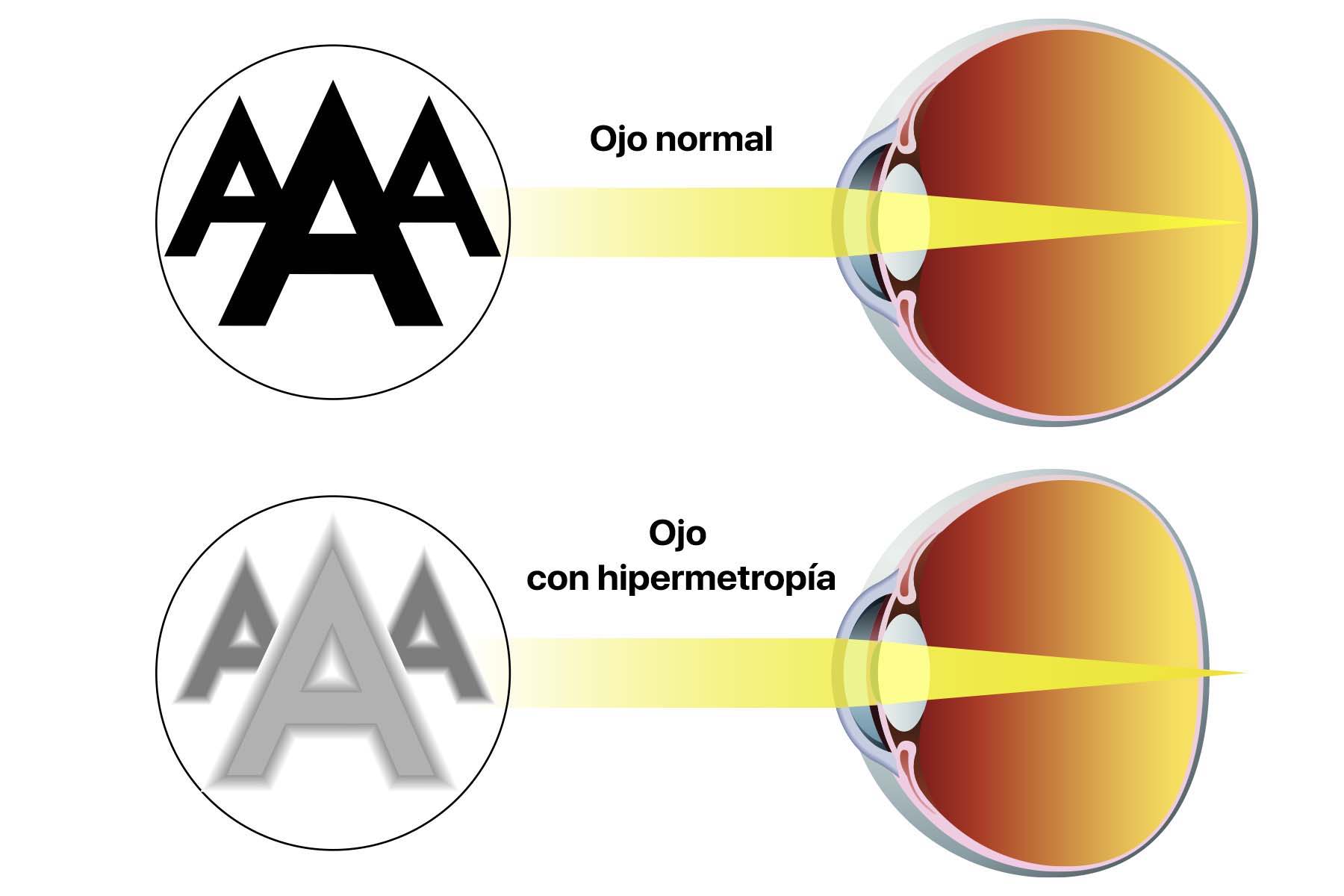 Gráfico en el que vemos tres letras A desde la visión de un ojo con hipermetropía y desde otro que no lo tiene. La idea es comparar las diferencias visuales que existen entre uno y otro.