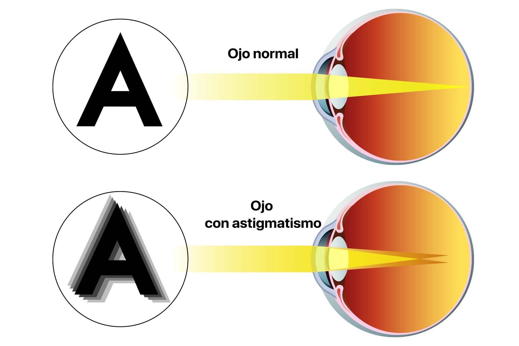 Gráfico en el que vemos la letra A desde la visión de un ojo con astigmatismo y desde otro que no lo tiene. La idea es comparar las diferencias visuales que existen entre uno y otro.