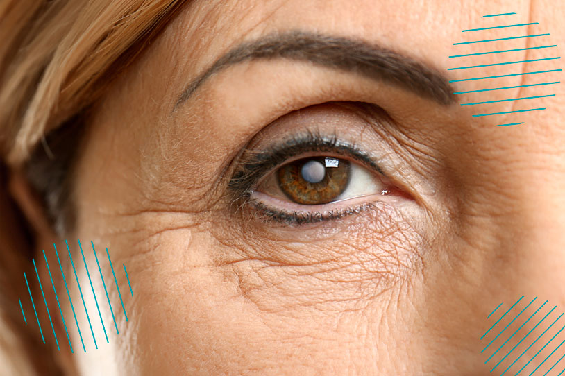Primer plano de mujer con cataratas